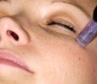 B-Dermapen Macchie
