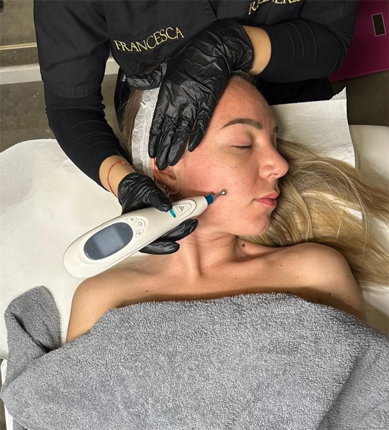 B-Dermapen acne attiva